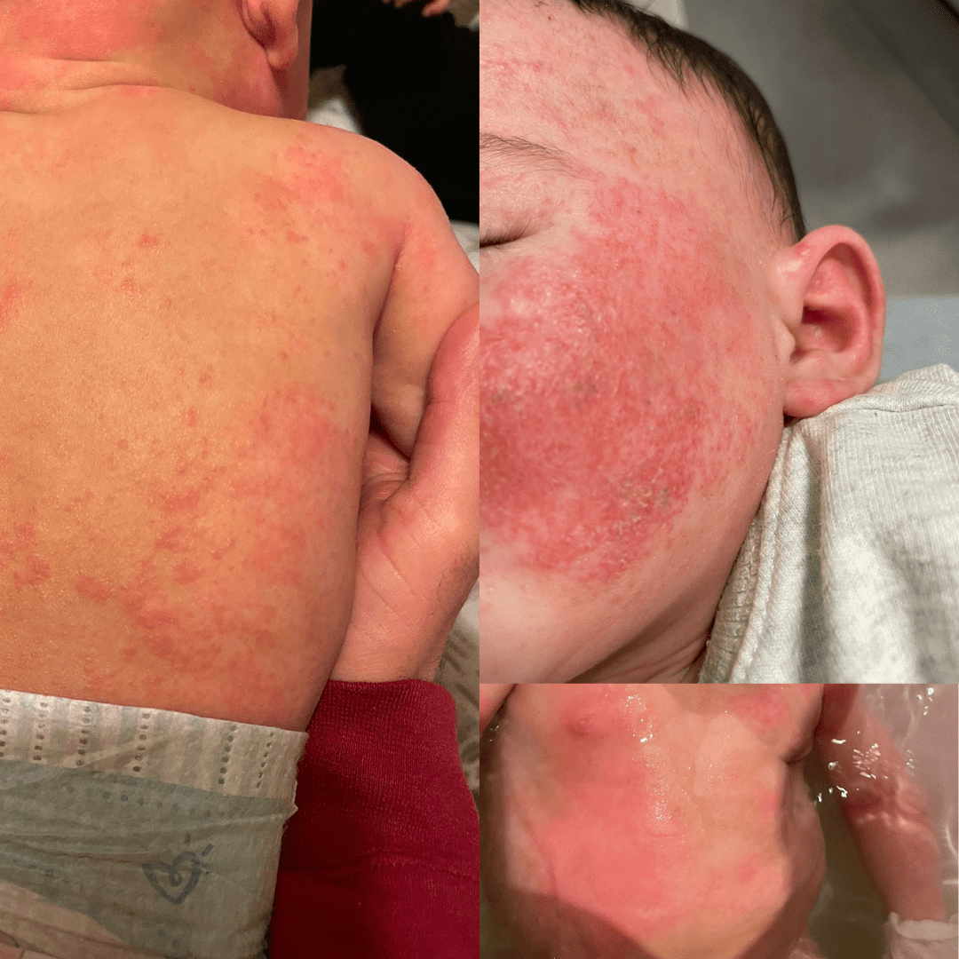 Chronic eczema baby Chronic eczema